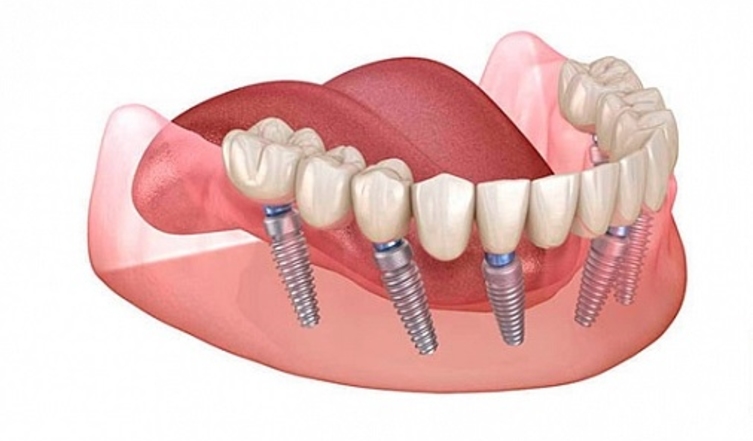 Имплантация по системе «все на 6»